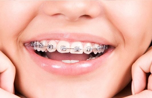 Tratamento Ortodôntico é disponibilizado aos militares