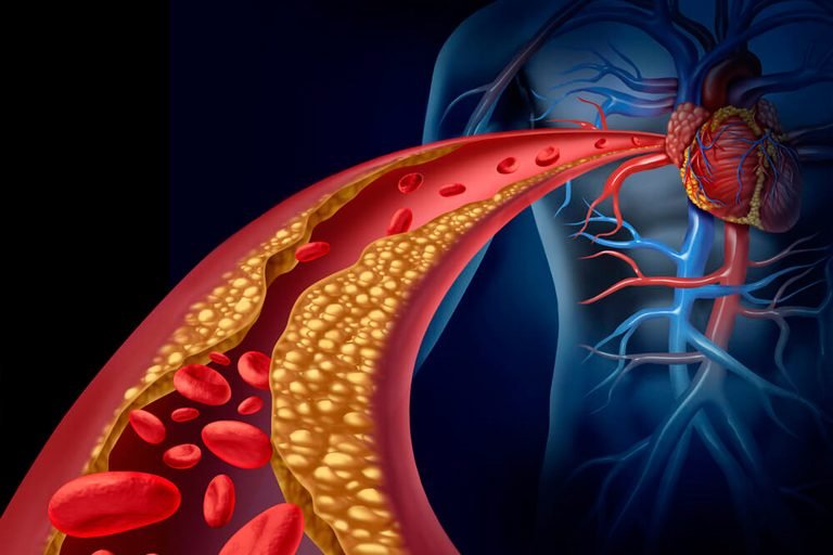 Colesterol alto e sedentarismo são inimigos do coração
