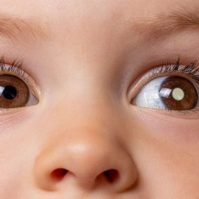 Retinoblastoma – conheça mais sobre essa doença